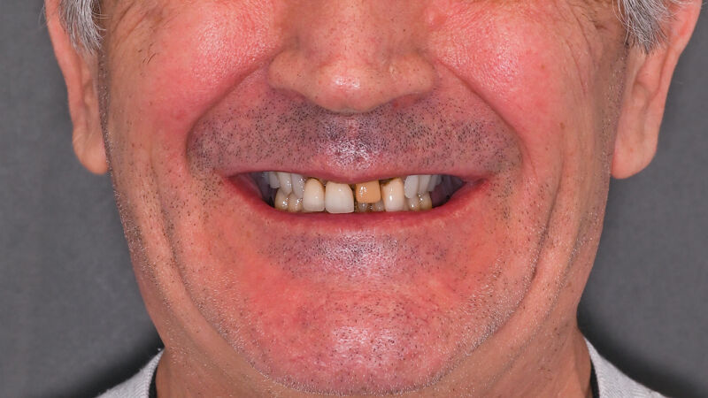 Zâmbet lateral stanga_înainte